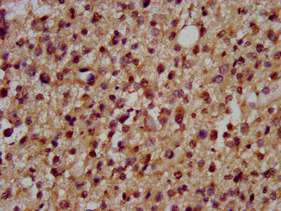IHC image of CSB-PA007192LA01HU diluted at 1:200 and staining in paraffin-embedded human glioma performed on a Leica BondTM system. After dewaxing and hydration, antigen retrieval was mediated by high pressure in a citrate buffer (pH 6.0). Section...