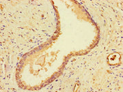 Immunohistochemistry of paraffin-embedded human prostate cancer using CSB-PA007211LA01HU at dilution of 1:100