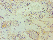 Immunohistochemistry of paraffin-embedded human breast cancer using CSB-PA007347ESR2HU at dilution of 1:100