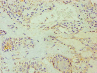Immunohistochemistry of paraffin-embedded human breast cancer using CSB-PA007347ESR2HU at dilution of 1:100