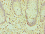 Immunohistochemistry of paraffin-embedded human colon cancer using CSB-PA007460ESR1HU at dilution of 1:100