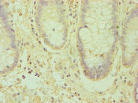 Immunohistochemistry of paraffin-embedded human colon cancer using CSB-PA007460ESR1HU at dilution of 1:100