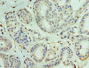 Immunohistochemistry of paraffin-embedded human breast cancer using CSB-PA007506DSR2HU at dilution of 1:100