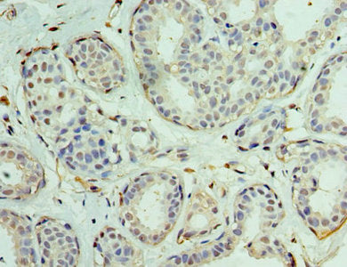 Immunohistochemistry of paraffin-embedded human breast cancer using CSB-PA007506DSR2HU at dilution of 1:100