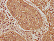 IHC image of CSB-PA007511LA01HU diluted at 1:600 and staining in paraffin-embedded human cervical cancer performed on a Leica BondTM system. After dewaxing and hydration, antigen retrieval was mediated by high pressure in a citrate buffer (pH 6.0)...