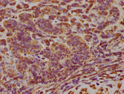 IHC image of CSB-PA007512LA01HU diluted at 1:300 and staining in paraffin-embedded human ovarian cancer performed on a Leica BondTM system. After dewaxing and hydration, antigen retrieval was mediated by high pressure in a citrate buffer (pH 6.0)....