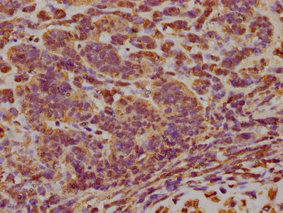 IHC image of CSB-PA007512LA01HU diluted at 1:300 and staining in paraffin-embedded human ovarian cancer performed on a Leica BondTM system. After dewaxing and hydration, antigen retrieval was mediated by high pressure in a citrate buffer (pH 6.0)....