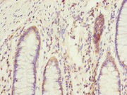 Immunohistochemistry of paraffin-embedded human colon cancer using CSB-PA007515ESR2HU at dilution of 1:100