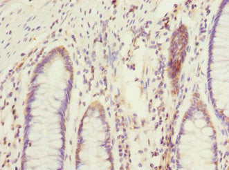 Immunohistochemistry of paraffin-embedded human colon cancer using CSB-PA007515ESR2HU at dilution of 1:100