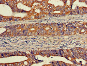 Immunohistochemistry of paraffin-embedded human colon cancer using CSB-PA007523LA01HU at dilution of 1:100