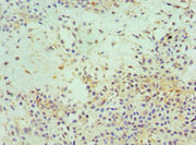 Immunohistochemistry of paraffin-embedded human breast cancer using CSB-PA007534ESR1HU at dilution of 1:100