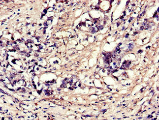 Immunohistochemistry of paraffin-embedded human gastric cancer using CSB-PA007553LA01HU at dilution of 1:100