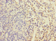 Immunohistochemistry of paraffin-embedded human bladder cancer using CSB-PA007558ESR1HU at dilution of 1:100
