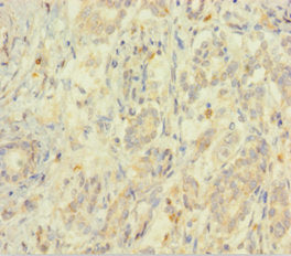 Immunohistochemistry of paraffin-embedded human pancreatic cancer using CSB-PA007572HA01HU at dilution of 1:100