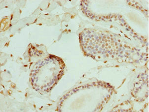 Immunohistochemistry of paraffin-embedded human breast cancer using CSB-PA007596DSR2HU at dilution of 1:100