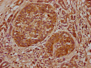 IHC image of CSB-PA007598LA01HU diluted at 1:500 and staining in paraffin-embedded human pancreatic cancer performed on a Leica BondTM system. After dewaxing and hydration, antigen retrieval was mediated by high pressure in a citrate buffer (pH 6....
