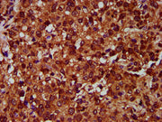 IHC image of CSB-PA007649LA01HU diluted at 1:400 and staining in paraffin-embedded human glioma performed on a Leica BondTM system. After dewaxing and hydration, antigen retrieval was mediated by high pressure in a citrate buffer (pH 6.0). Section...