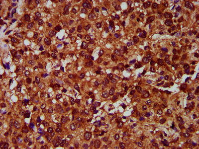 IHC image of CSB-PA007649LA01HU diluted at 1:400 and staining in paraffin-embedded human glioma performed on a Leica BondTM system. After dewaxing and hydration, antigen retrieval was mediated by high pressure in a citrate buffer (pH 6.0). Section...