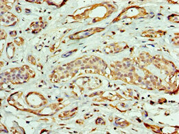 Immunohistochemistry of paraffin-embedded human breast cancer using CSB-PA007666ESR2HU at dilution of 1:100
