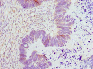 Immunohistochemistry of paraffin-embedded human ovarian cancer using CSB-PA007677ESR1HU at dilution of 1:100