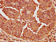IHC image of CSB-PA007761LA01HU diluted at 1:200 and staining in paraffin-embedded human cervical cancer performed on a Leica BondTM system. After dewaxing and hydration, antigen retrieval was mediated by high pressure in a citrate buffer (pH 6.0)...