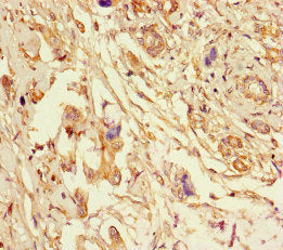 Immunohistochemistry of paraffin-embedded human pancreatic cancer using CSB-PA007791LA01HU at dilution of 1:100