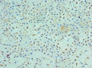 Immunohistochemistry of paraffin-embedded human breast cancer using CSB-PA007860ESR1HU at dilution of 1:100