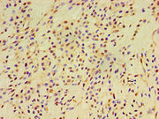Immunohistochemistry of paraffin-embedded human breast cancer using CSB-PA007878ESR1HU at dilution of 1:100