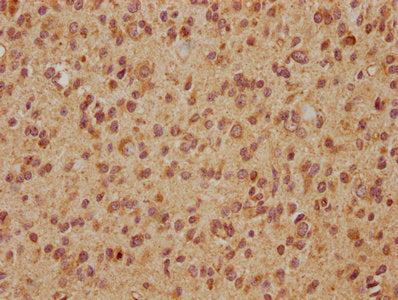 IHC image of CSB-PA007886LA01HU diluted at 1:560 and staining in paraffin-embedded human glioma cancer performed on a Leica BondTM system. After dewaxing and hydration, antigen retrieval was mediated by high pressure in a citrate buffer (pH 6.0)....