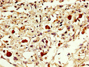 IHC image of CSB-PA007889LA01HU diluted at 1:300 and staining in paraffin-embedded human melanoma performed on a Leica BondTM system. After dewaxing and hydration, antigen retrieval was mediated by high pressure in a citrate buffer (pH 6.0). Secti...