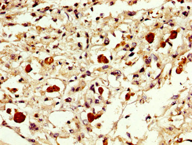 IHC image of CSB-PA007889LA01HU diluted at 1:300 and staining in paraffin-embedded human melanoma performed on a Leica BondTM system. After dewaxing and hydration, antigen retrieval was mediated by high pressure in a citrate buffer (pH 6.0). Secti...