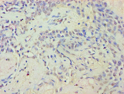 Immunohistochemistry of paraffin-embedded human breast cancer using CSB-PA007907LA01HU at dilution of 1:100
