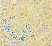 Immunohistochemistry of paraffin-embedded human liver cancer using CSB-PA007930HA01HU at dilution of 1:100