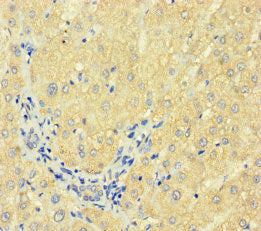 Immunohistochemistry of paraffin-embedded human liver cancer using CSB-PA007930HA01HU at dilution of 1:100