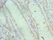 Immunohistochemistry of paraffin-embedded human colon cancer using CSB-PA007955ESR1HU at dilution of 1:100