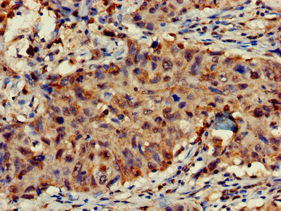 Immunohistochemistry of paraffin-embedded human lung cancer using CSB-PA007987LA01HU at dilution of 1:100