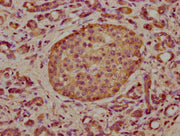 IHC image of CSB-PA008015LA01HU diluted at 1:300 and staining in paraffin-embedded human pancreatic cancer performed on a Leica BondTM system. After dewaxing and hydration, antigen retrieval was mediated by high pressure in a citrate buffer (pH 6....