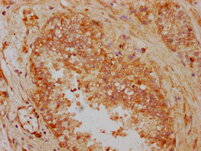 IHC image of CSB-PA008075LA01HU diluted at 1:300 and staining in paraffin-embedded human prostate cancer performed on a Leica BondTM system. After dewaxing and hydration, antigen retrieval was mediated by high pressure in a citrate buffer (pH 6.0)...