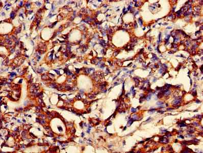 Immunohistochemistry of paraffin-embedded human gastric cancer using CSB-PA008125LA01HU at dilution of 1:100