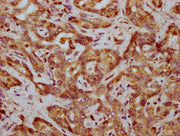 IHC image of CSB-PA008345LA01HU diluted at 1:400 and staining in paraffin-embedded human liver cancer performed on a Leica BondTM system. After dewaxing and hydration, antigen retrieval was mediated by high pressure in a citrate buffer (pH 6.0). S...