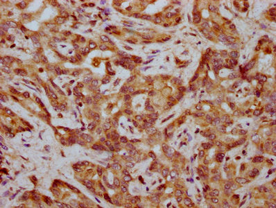 IHC image of CSB-PA008345LA01HU diluted at 1:400 and staining in paraffin-embedded human liver cancer performed on a Leica BondTM system. After dewaxing and hydration, antigen retrieval was mediated by high pressure in a citrate buffer (pH 6.0). S...