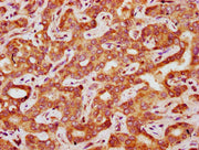 IHC image of CSB-PA008447LA01HU diluted at 1:200 and staining in paraffin-embedded human liver cancer performed on a Leica BondTM system. After dewaxing and hydration, antigen retrieval was mediated by high pressure in a citrate buffer (pH 6.0). S...