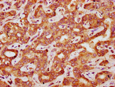 IHC image of CSB-PA008447LA01HU diluted at 1:200 and staining in paraffin-embedded human liver cancer performed on a Leica BondTM system. After dewaxing and hydration, antigen retrieval was mediated by high pressure in a citrate buffer (pH 6.0). S...
