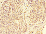 Immunohistochemistry of paraffin-embedded human ovarian cancer using CSB-PA008542ESR1HU at dilution of 1:100