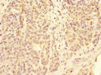 Immunohistochemistry of paraffin-embedded human ovarian cancer using CSB-PA008542ESR1HU at dilution of 1:100