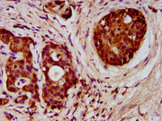 IHC image of CSB-PA008546LA01HU diluted at 1:300 and staining in paraffin-embedded human pancreatic cancer performed on a Leica BondTM system. After dewaxing and hydration, antigen retrieval was mediated by high pressure in a citrate buffer (pH 6....
