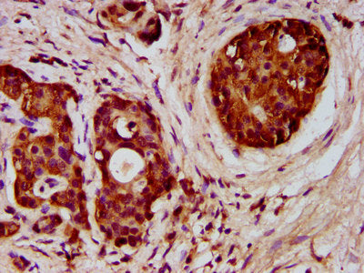 IHC image of CSB-PA008546LA01HU diluted at 1:300 and staining in paraffin-embedded human pancreatic cancer performed on a Leica BondTM system. After dewaxing and hydration, antigen retrieval was mediated by high pressure in a citrate buffer (pH 6....