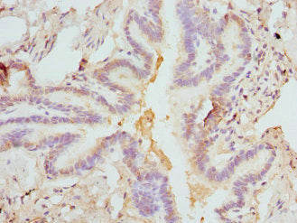 Immunohistochemistry of paraffin-embedded human lung tissue using CSB-PA008550ESR1HU at dilution of 1:100