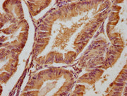 IHC image of CSB-PA008631OA01HU diluted at 1:300 and staining in paraffin-embedded human endometrial cancer performed on a Leica BondTM system. After dewaxing and hydration, antigen retrieval was mediated by high pressure in a citrate buffer (pH 6...