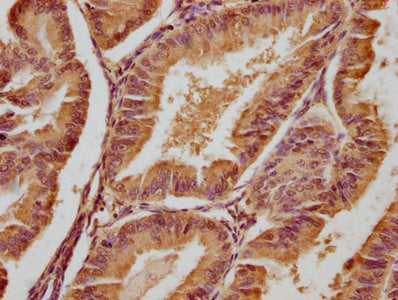 IHC image of CSB-PA008631OA01HU diluted at 1:300 and staining in paraffin-embedded human endometrial cancer performed on a Leica BondTM system. After dewaxing and hydration, antigen retrieval was mediated by high pressure in a citrate buffer (pH 6...